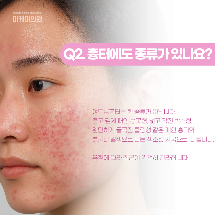 Why Don’t Gangnam Acne Scars Disappear on Their Own? image 3
