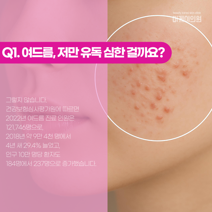 강남 여드름 피부과, 언제부터 가야 할까? 관련 이미지 2
