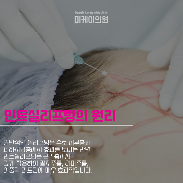 강남 민트실리프팅 빠르고 확실한 변화 관련 이미지 2
