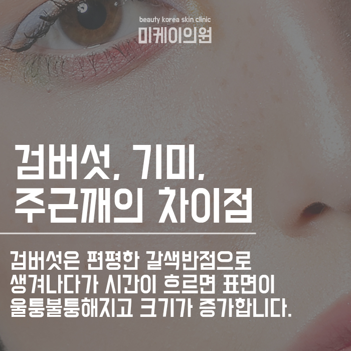 검버섯 레이저 후 관리 피부고민 해결하세요! 관련 이미지 2