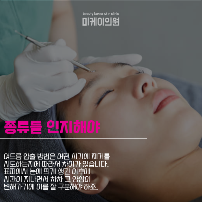 여드름 압출 방법 상처 생기지 않도록 관련 이미지 2