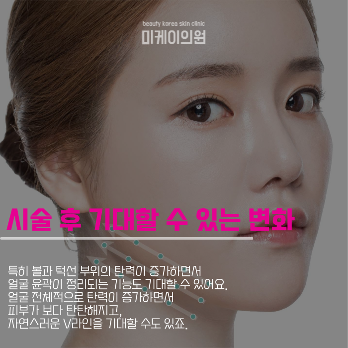 Undergoing an InMode Procedure at a Gangnam Sunday Dermatology Clinic image 3
