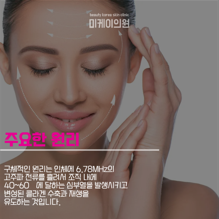 올리지오 시술 주기 궁금하셨다면 관련 이미지 2