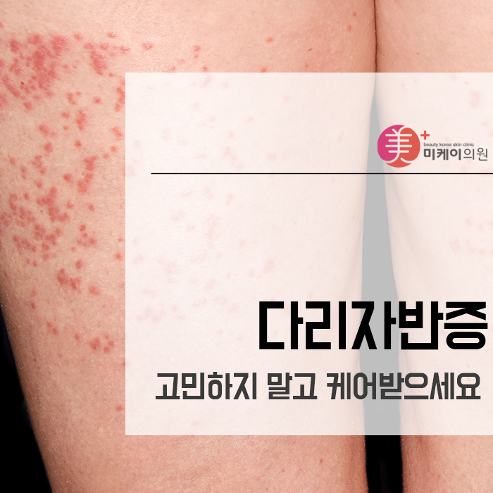 다리자반증 고민하지 말고 케어받으세요 관련 이미지 1