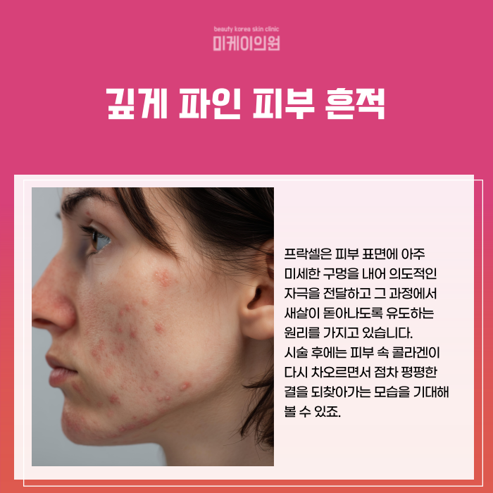 강남역 여드름흉터 매끈하게 채우는 법 관련 이미지 2