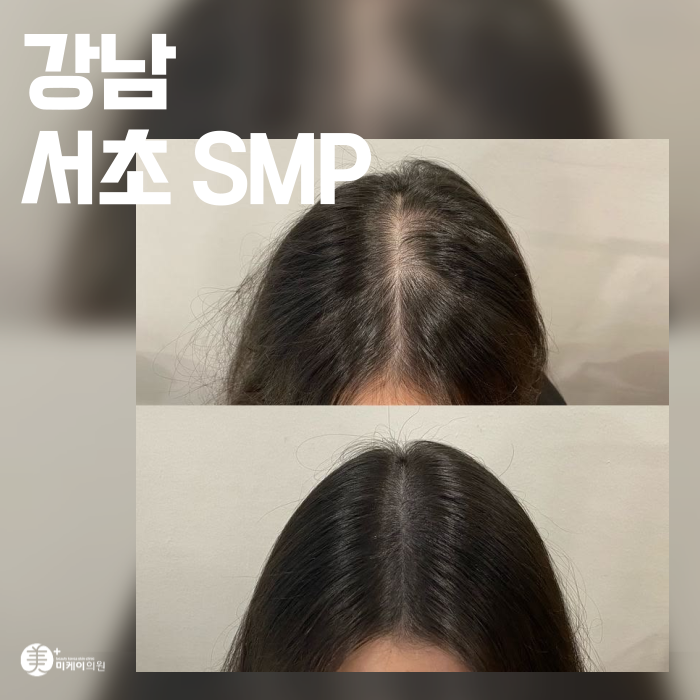 If You’re Concerned About a Thin Crown in Gangnam Seocho SMP image 1