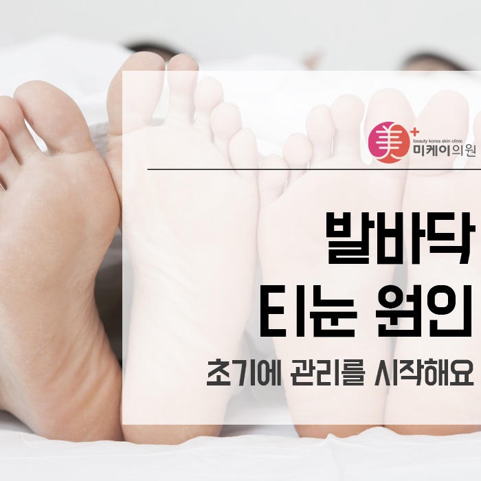 발바닥 티눈 원인 초기에 관리를 시작해요 관련 이미지 1