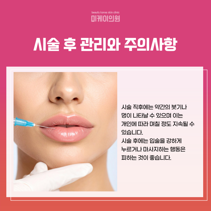 Where to Get Lip Fillers Near Gangnam Station: A Natural Design image 5