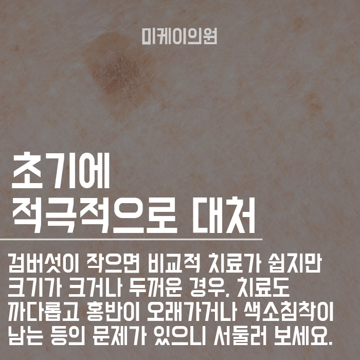 20대 검버섯 피부과치료 미케이의원과 함께해요 관련 이미지 3