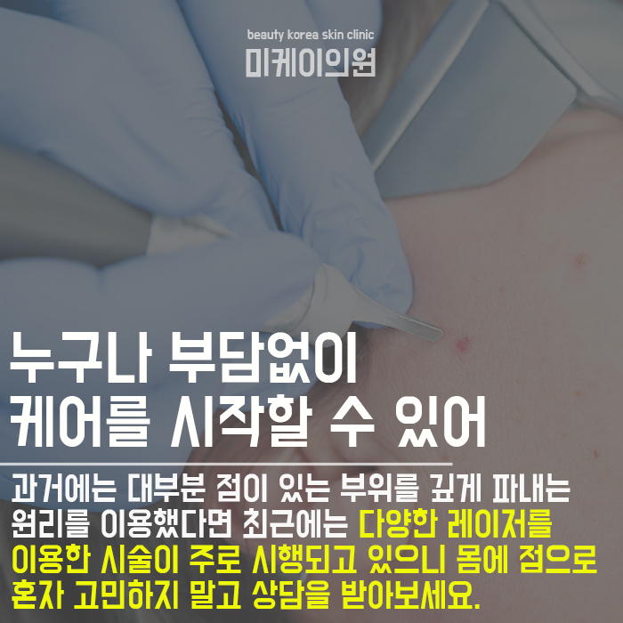 몸에점이많아요 관심이 필요한 이유 관련 이미지 4
