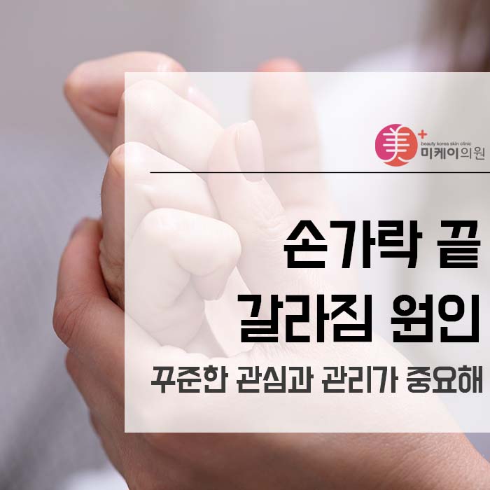 손가락끝갈라짐원인 꾸준한 관심과 관리가 중요해 관련 이미지 1