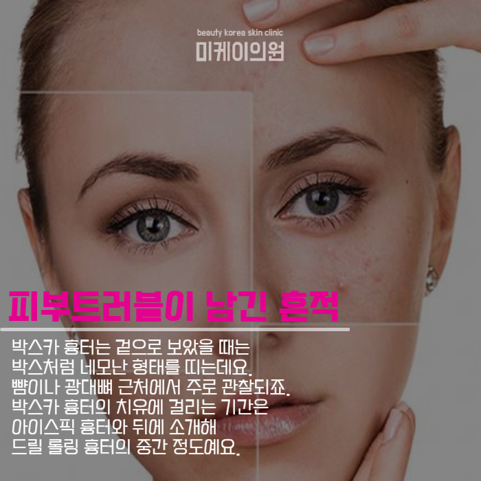 여드름자국치료 균일하고 매끄럽게 관련 이미지 3