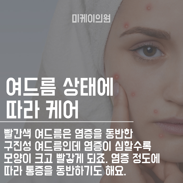 여드름없애는 관리방법 관련 이미지 4