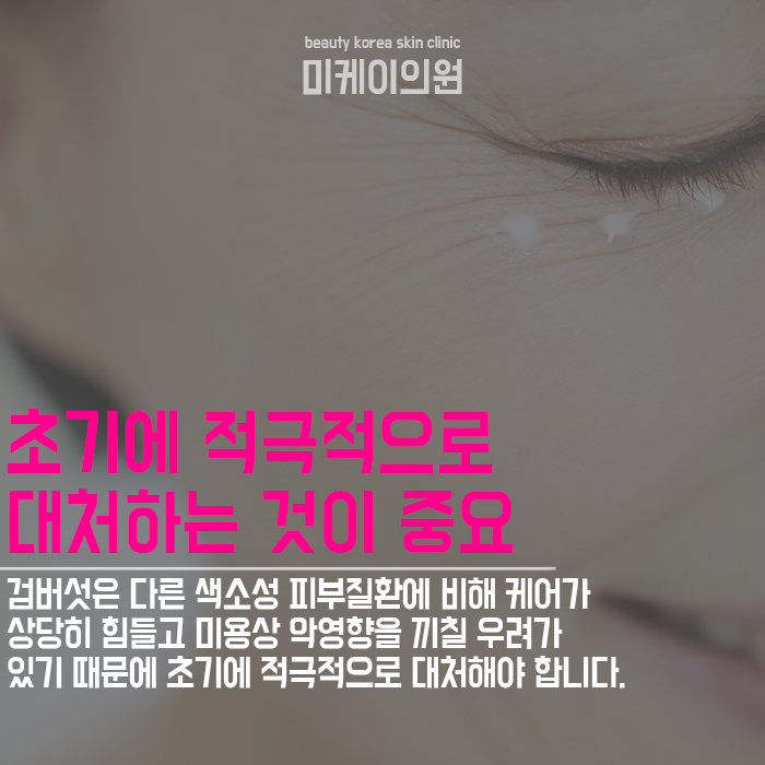 검버섯에좋은음식 셀프관리로 변화가 없다면 상담부터 관련 이미지 3