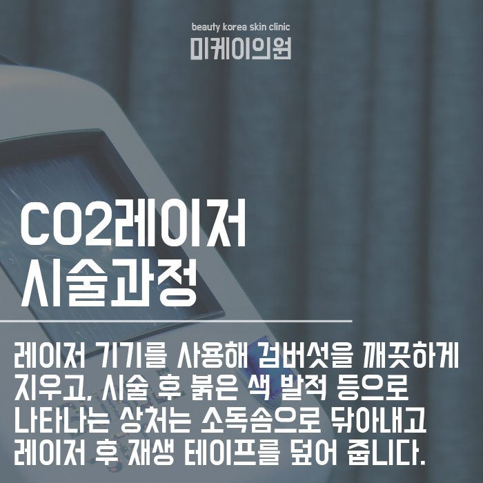 검버섯 레이저 후 관리 피부고민 해결하세요! 관련 이미지 4