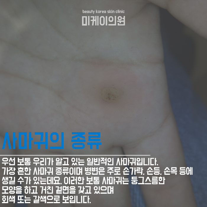 사마귀생기는이유 원인을 알고 예방해요 관련 이미지 2