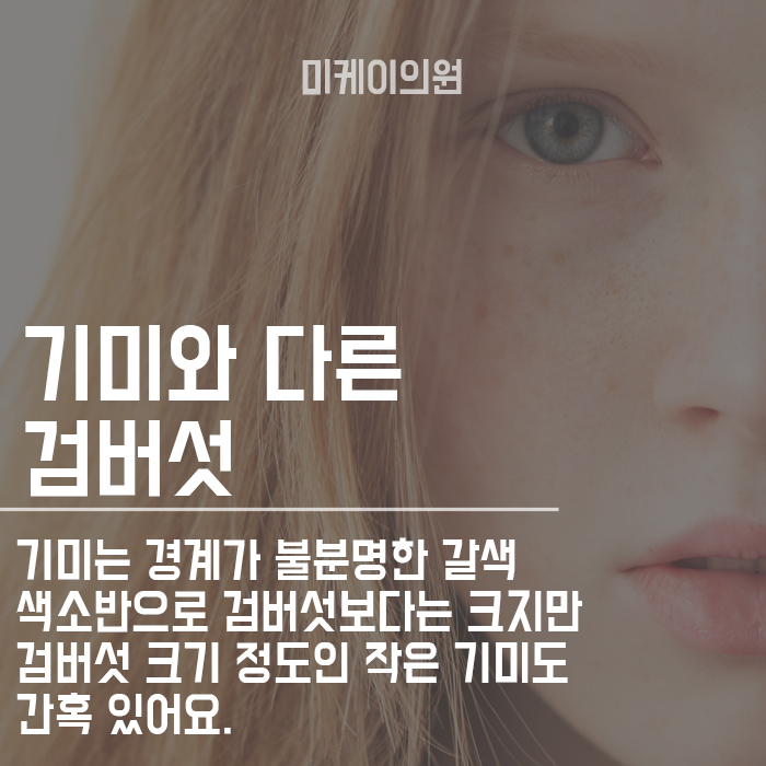 20대 검버섯 피부과치료 미케이의원과 함께해요 관련 이미지 4