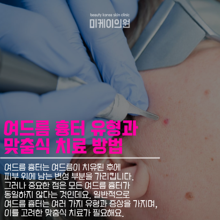 서초흉터병원 여드름 흉터 치료와 맞춤형 시술 관련 이미지 2
