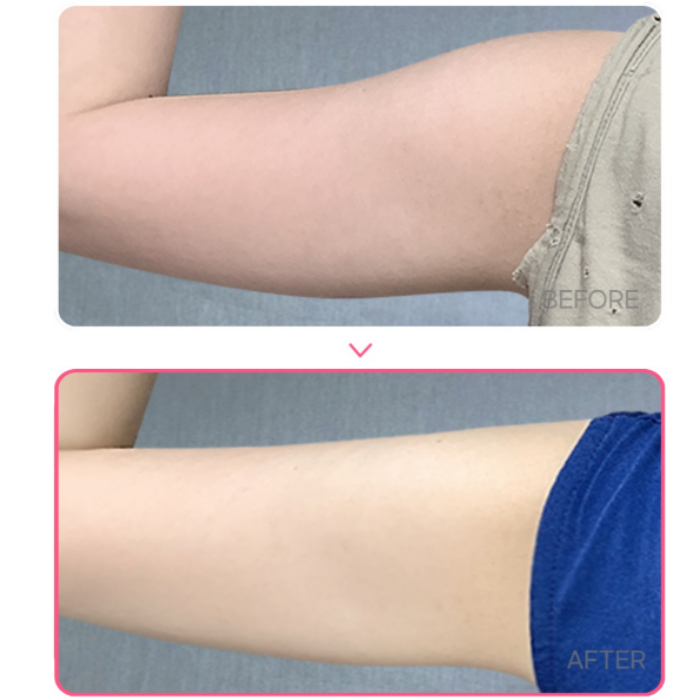 Three Solutions for Losing Upper Arm Fat in Seocho image 7