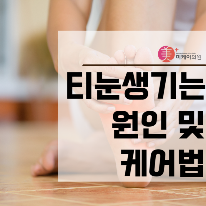 티눈생기는원인 및 케어법 알아보기 관련 이미지 1