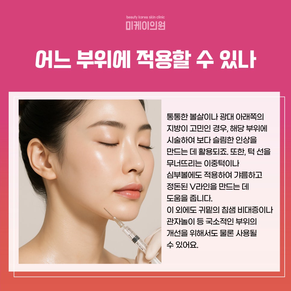 서초구 윤곽주사 부위 얼굴형에 따라 달라 관련 이미지 3