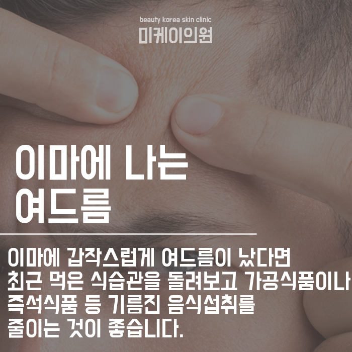 여드름 위치별 건강 상태 체크할 수 있어요! 관련 이미지 2