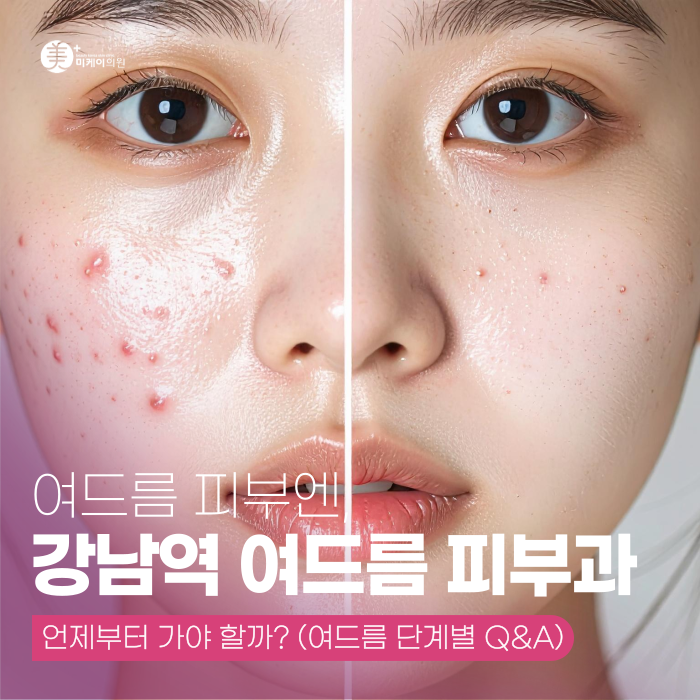강남 여드름 피부과, 언제부터 가야 할까? 관련 이미지 1