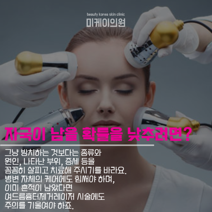 여드름흉터제거레이저 짧은 시간에 간단하게 관련 이미지 3