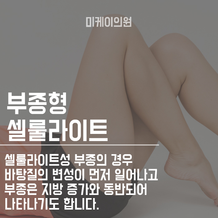 셀룰라이트 없애는방법 매끈한 다리 라인을 위하여 관련 이미지 3
