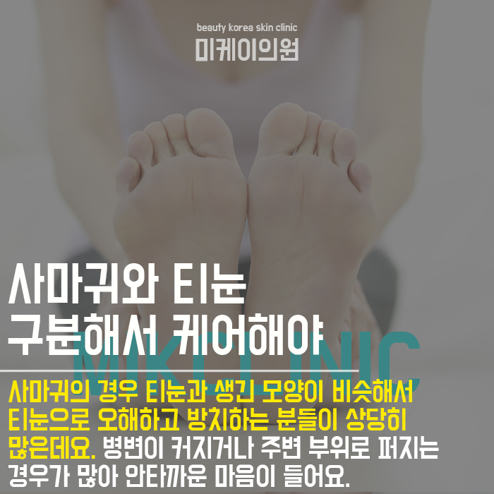 발바닥 티눈 원인 초기에 관리를 시작해요 관련 이미지 2