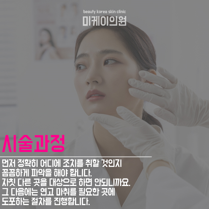 강남역입꼬리보톡스 알아보자 관련 이미지 4
