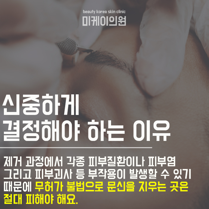 문신제거치료기간 미리 고려해요 관련 이미지 4