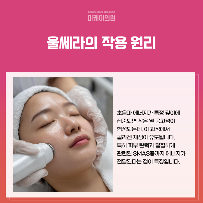 서초 울쎄라 병원 리프팅 시술의 원리와 효과 관련 이미지 2