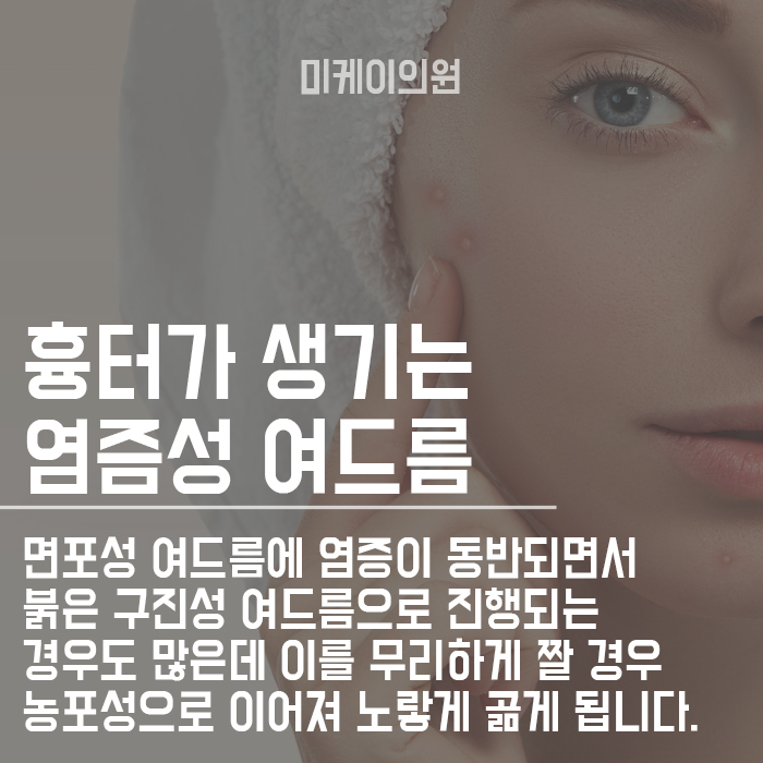 면포성여드름 초기관리 늦지 않게 관리해야 합니다. 관련 이미지 3
