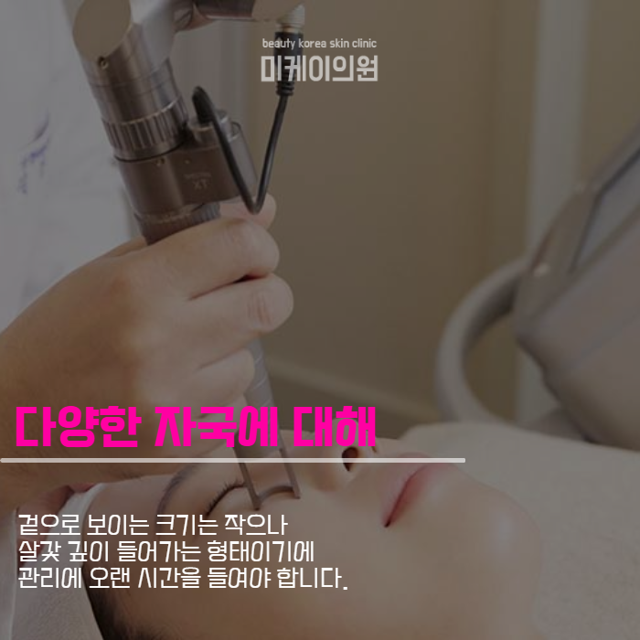 여드름흉터제거레이저 짧은 시간에 간단하게 관련 이미지 4