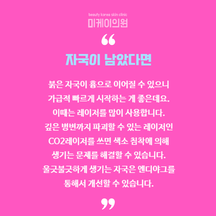 여드름 압출 방법 상처 생기지 않도록 관련 이미지 6