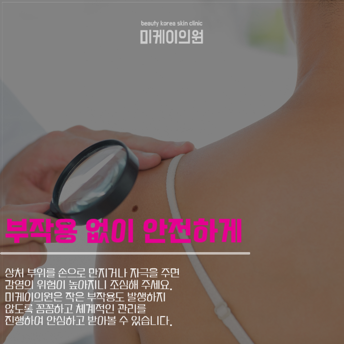 강남점제거 맑고 깨끗한 피부 관련 이미지 4