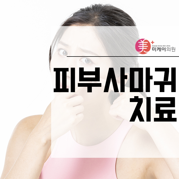 피부사마귀치료 사소한 증상도 무시할 수 없어요 관련 이미지 1