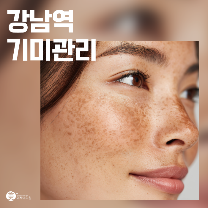 Can Melasma Be Removed in Just One Treatment at Gangnam Station? image 1