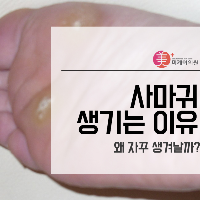 사마귀 생기는 이유 왜 자꾸 생겨날까? 관련 이미지 1