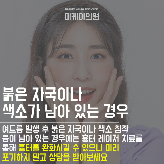 여드름검은색원인 개인에 따라 원인이 달라 관련 이미지 6
