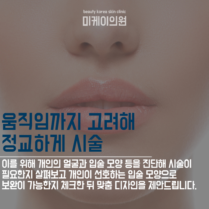 서초입술필러추천 입술의 밸런스를 조절하여 비대칭까지 개선해요 관련 이미지 3
