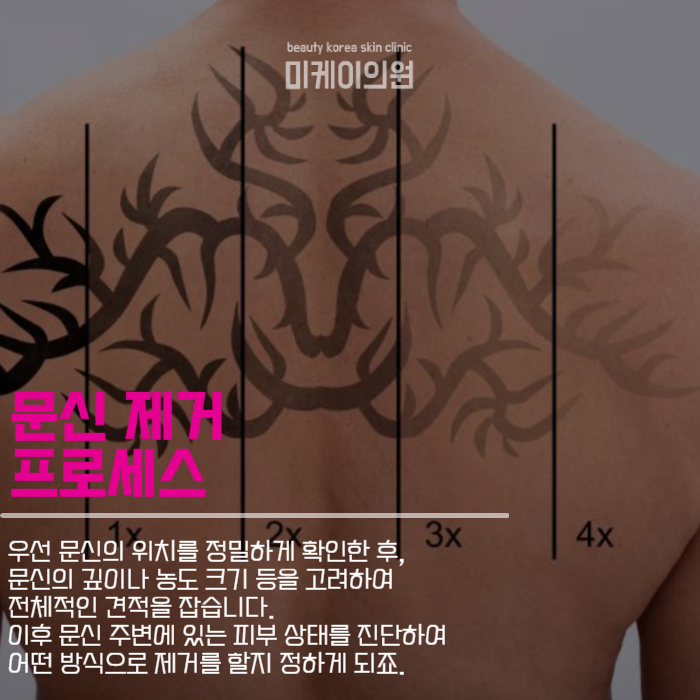 문신제거기간 및 주의사항 살펴보기 관련 이미지 3