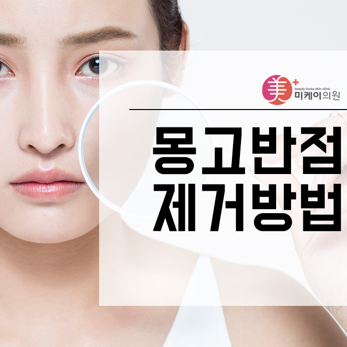 몽고반점제거방법 개인의 피부 타입을 고려해야 관련 이미지 1