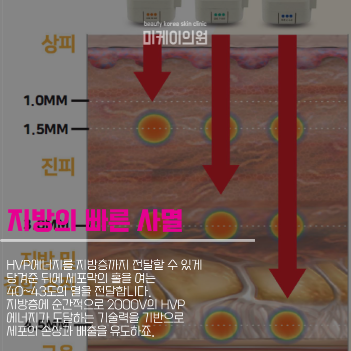 강남 인모드fx 얼굴 라인을 깔끔하게 관련 이미지 2