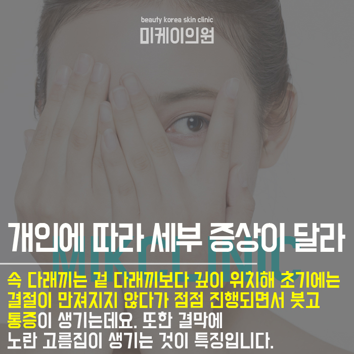 눈두덩이빨갛게되는이유 개인에 따라 달라요 관련 이미지 3