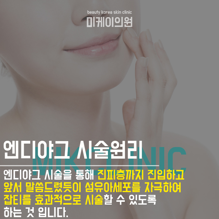 강남역기미레이저 시술 미케이의원에서 관련 이미지 4