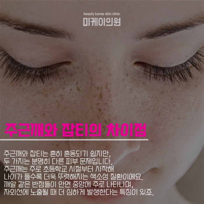 강남피부과 의원 주근깨와 잡티 완벽 제거 관련 이미지 2