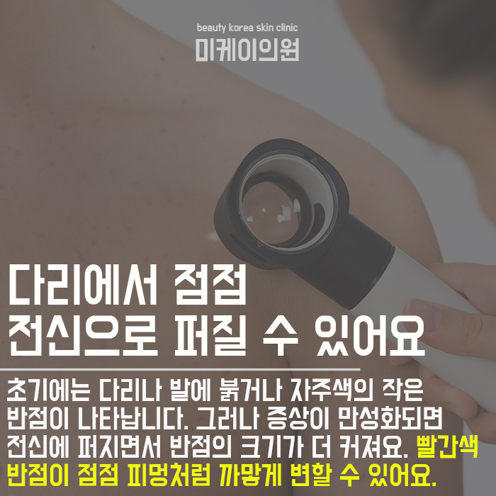 다리자반증 고민하지 말고 케어받으세요 관련 이미지 3