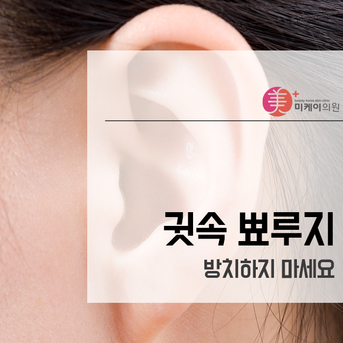 귓속 뾰루지 방치하지 마세요 관련 이미지 1